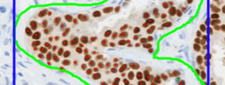 Image for the Companion Algorithm Estrogen Receptor (ER) (SP1) image analysis software